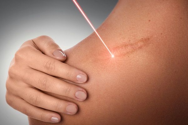Stretch Mark Removal